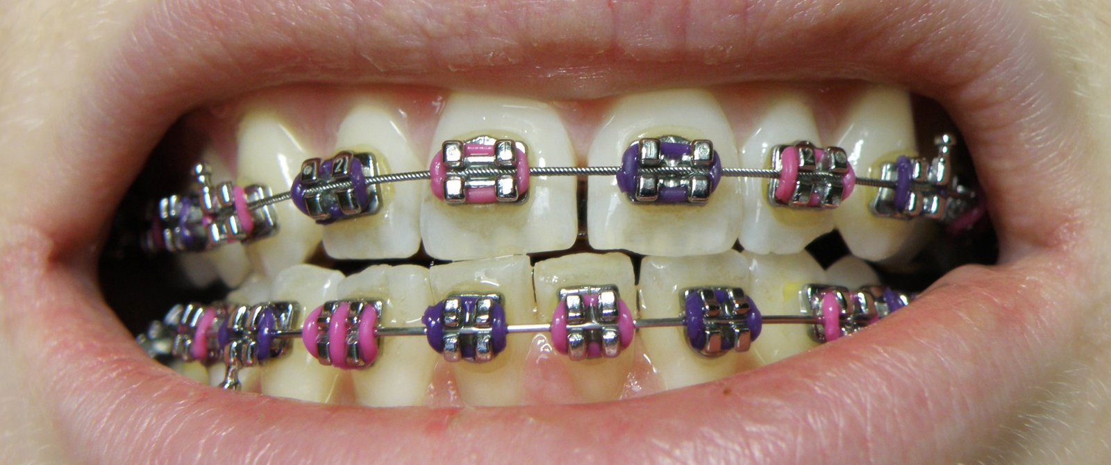 Orthodontics / Braces