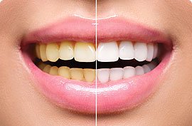 Bleaching / Teeth Whitening